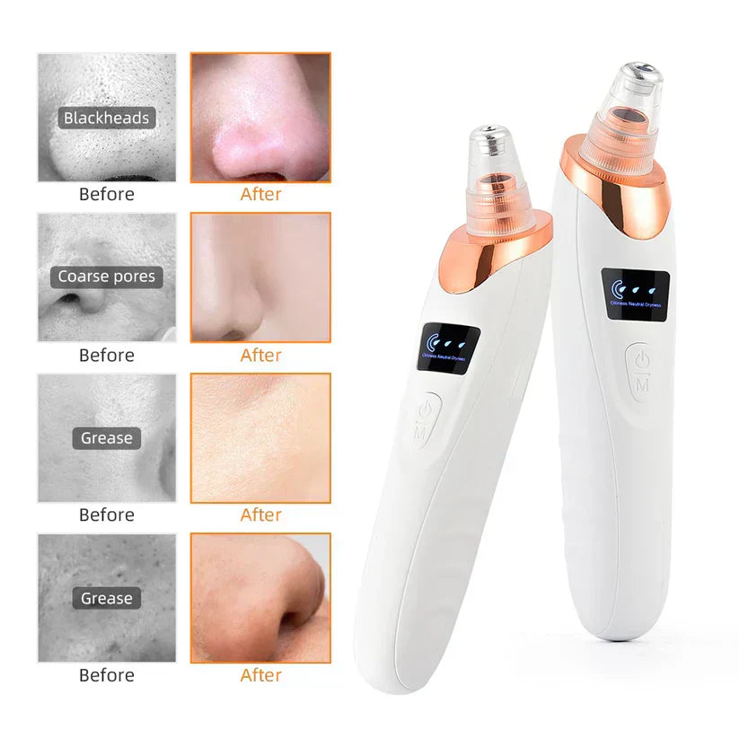 Premium Quality 5 IN 1 Blackheads Remover Vacuum Rechargable